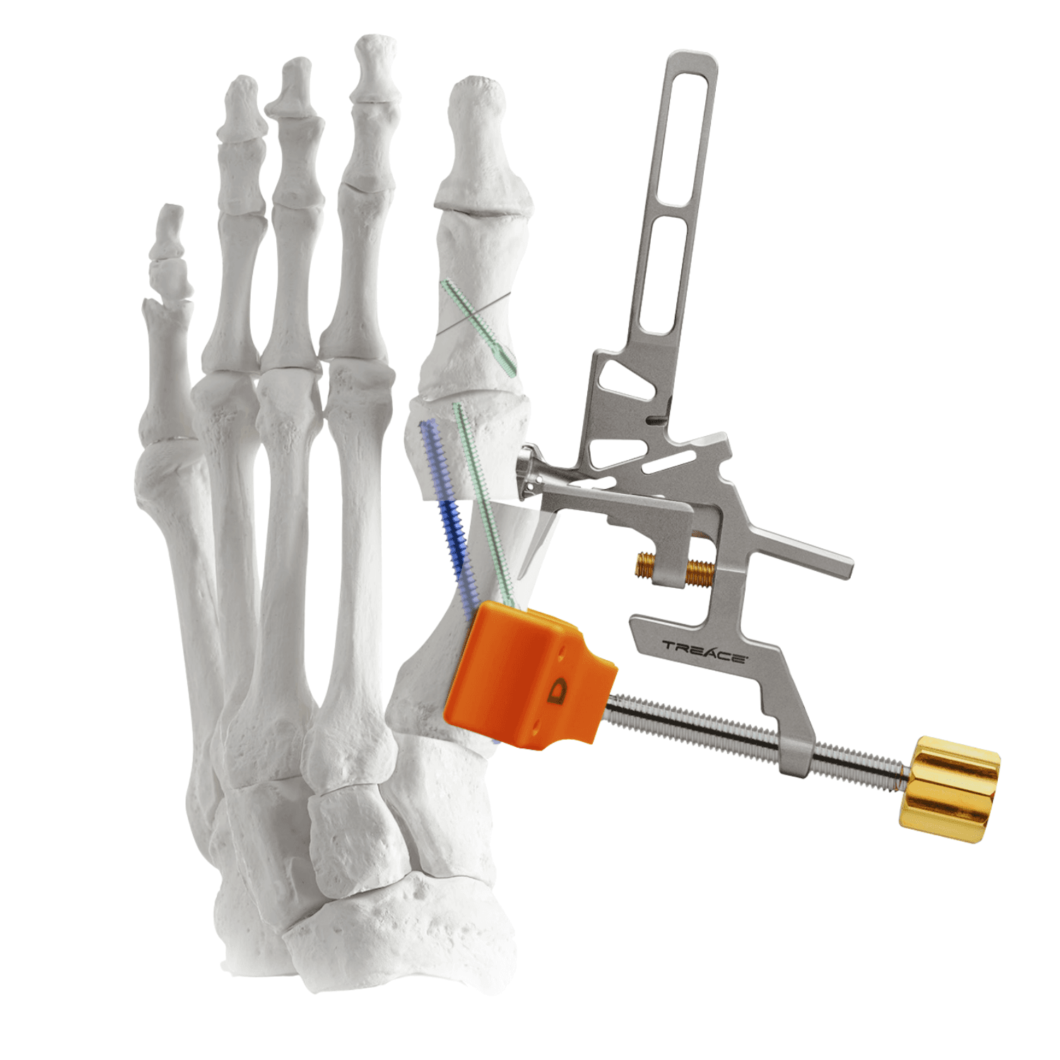 Image of Percuplasty 1