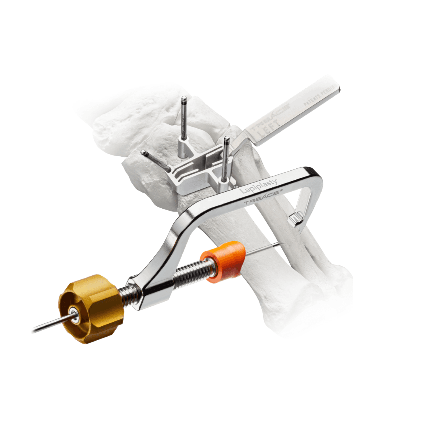 Image of Lapiplasty 1